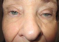 Upper Eyelid Lift or Blepharoplasty