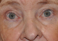 Upper Eyelid Lift or Blepharoplasty