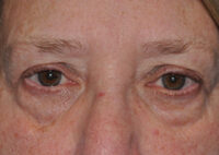 Upper Eyelid Lift or Blepharoplasty