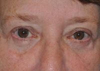 Upper Eyelid Lift or Blepharoplasty