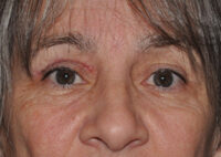 Eyebrow Lift or Forehead Lift