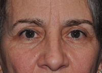 Eyebrow Lift or Forehead Lift