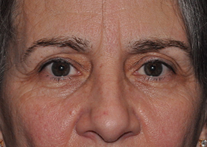 Eyebrow Lift or Forehead Lift