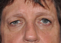 Eyebrow Lift or Forehead Lift