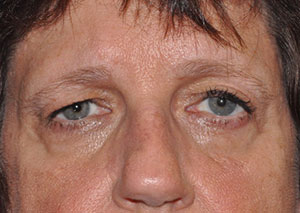 Eyebrow Lift or Forehead Lift